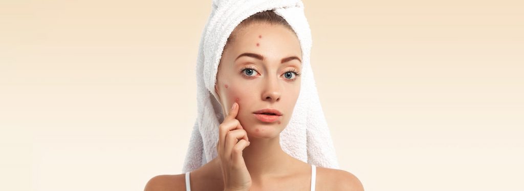 como combatir el acne hormonal
